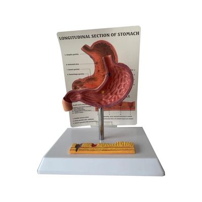 Model stomac. Stadiile ulcerului gastric